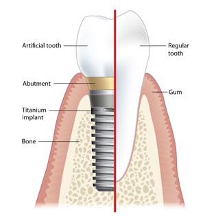 Artificial tooth