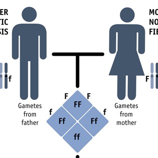 Cystic fibrosis infographic 