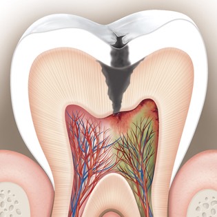 Diseased tooth