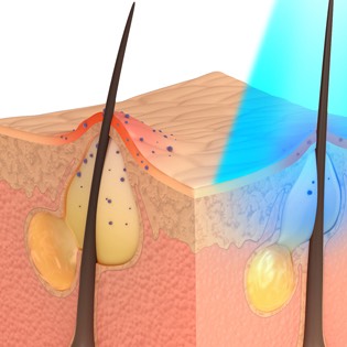 Acne skin illustration 